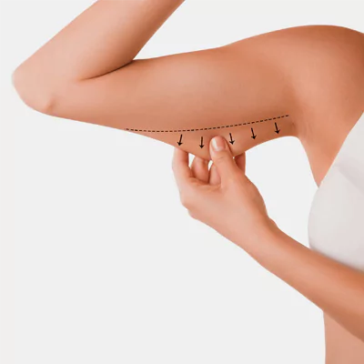 arm lift lina surgery istanbul health tourism turkey 65b29ee765bc7 Startseite