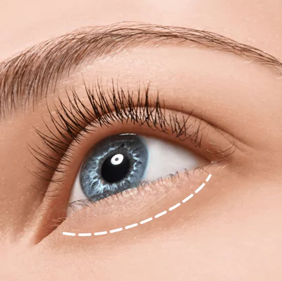 blepharoplasty 1 1 65c4e7dd87664 Blepharoplastik