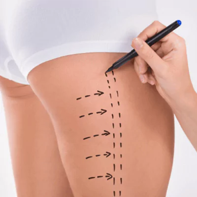 thigh lift lina surgery istanbul health tourism turkey 65b29ee607ddb Startseite