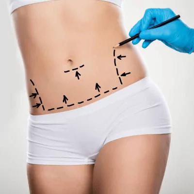 tummy tuck in turkey 2 1 65c4cc0fda1a3 Bauchdeckenstraffung