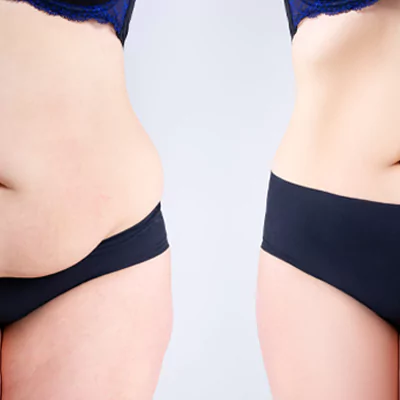 tummy tuck in turkey 65c4cc107feb9 Bauchdeckenstraffung