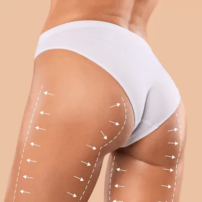 brazilian butt lift surgery informations bbl lina surgery istanbul health tourism turkey 65b1afd55d9fd Startseite Brazilian Butt Lift Surgery Informations BBL Lina Surgery İstanbul health tourism Turkey