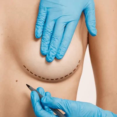 breast uplift lina surgery istanbul health tourism turkey 65b1afd5673a0 Startseite
