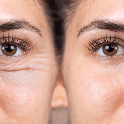 blepharoplasty 2 1 65c4e7de6748b BLEFAROPLASTİ