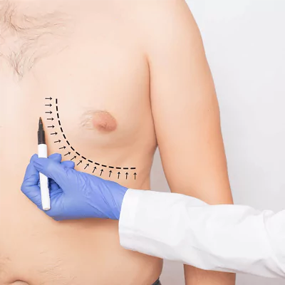 gynecomastia lina surgery istanbul health tourism turkey 65b29ee5dff73 Anasayfa