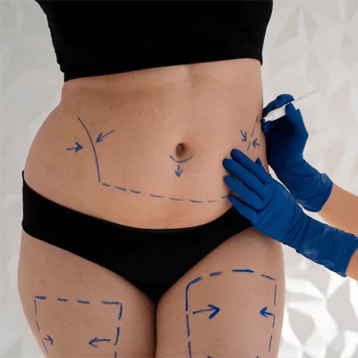 tummy tuck lina surgery istanbul health tourism turkey 65b1afcf50eff Anasayfa