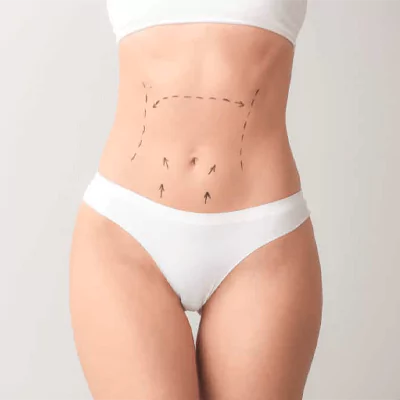 tummy tuck in turkey 1 1 65c4cc0f22571 KARIN GERME